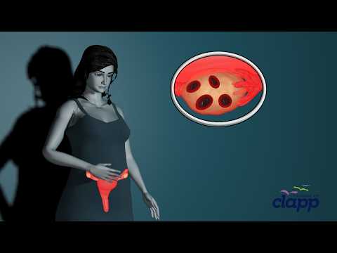 PCOS AND MENSTRATION ( 3D Animation )