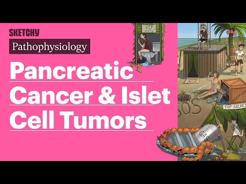 Pancreatic Cancer & Islet Cell Tumors (Pathophysiology) | Sketchy Medical