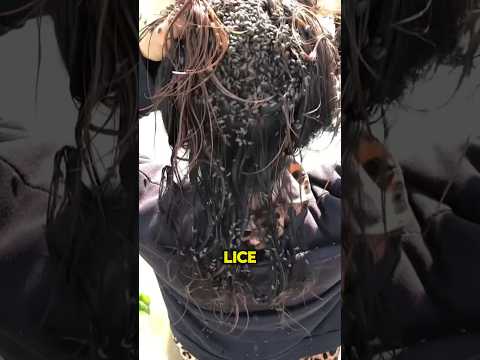 What Are These CREEPY Insects In Their Hair? 😨 #viral