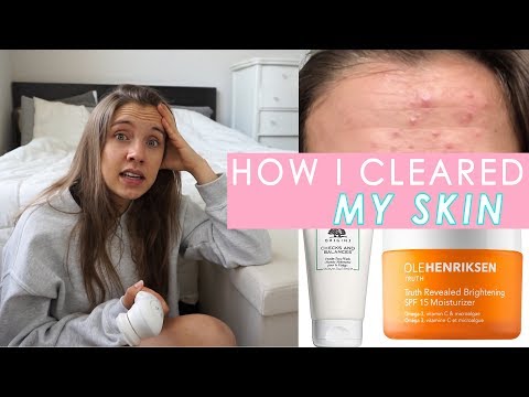 How I Cleared My Skin | Lifestyle Factors and Products