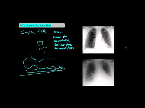 Types of Chest X-Rays part 2 - Lateral, Supine, Decubitus [UndergroundMed]