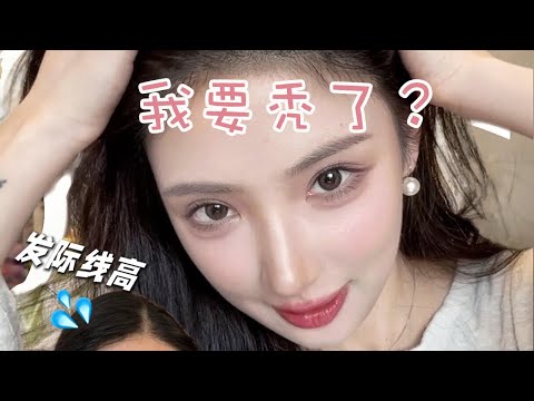 【How to Treat Hair Loss】脫髮怎麼辦？韓國Tony髮縫糾正大法