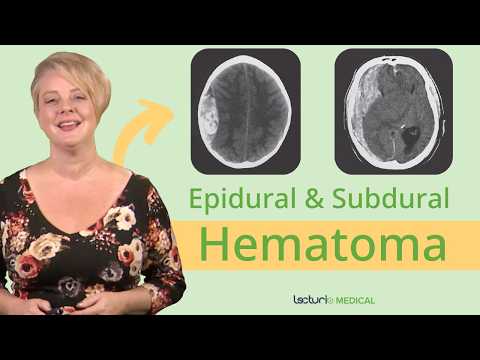 CT Imaging for Epidural Hematoma: What You Need to Know 🧠📊