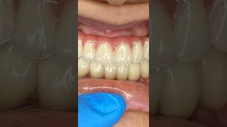 #dental #stom #stomatolog #implant