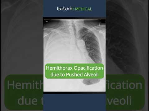 Hemithorax Opacification: Pushed Alveoli Explained 🩺 #ChestXray #Radiology #USMLE