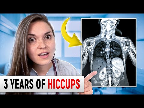 NONSTOP HICCUPS! An Endless Nightmare: Is There a CURE?!