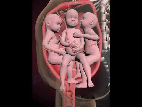 PRECIOUS MOMENTS OF TRIPLETS INSIDE THE WOMB  (3D ANIMATION)