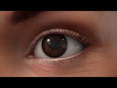 Glaucoma | MOA Animation