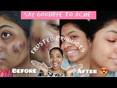 My Acne Transformation Products That Actually Work