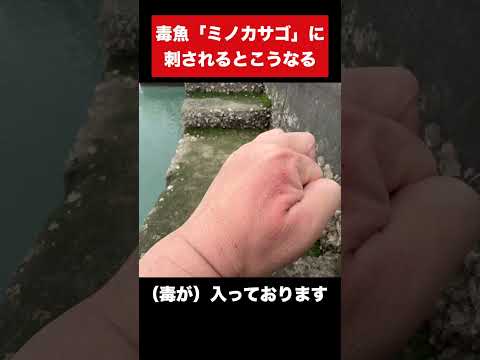 毒魚『ミノカサゴ』に刺されるとこうなる