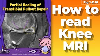 (Fig 1-E.16) Partial healing, a partial tear of Transtibial Pullout Repair